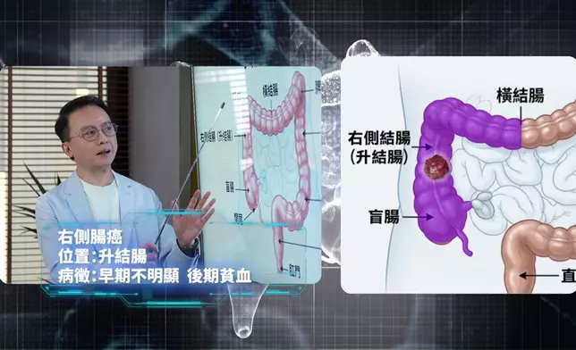 國際知名的腸胃病學專家陳家亮教授節目中將拆解大腸癌的真正成因，以及如何全面預防這項癌症。