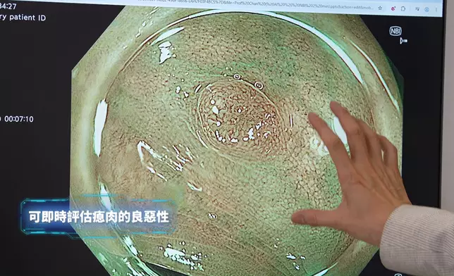 又會介紹AI如何協助更精準偵測大腸瘜肉。