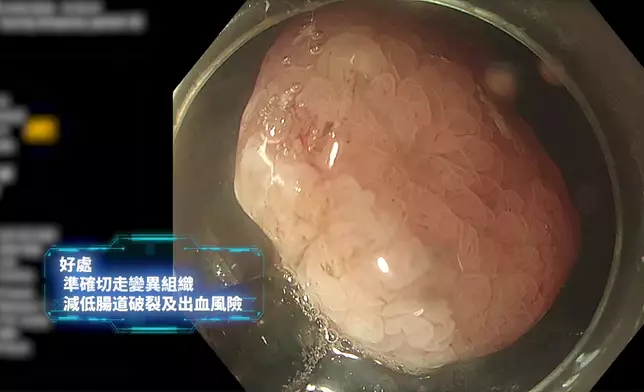 林秀怡直擊ESD微創術「免全身麻醉」切除大腸瘜肉。