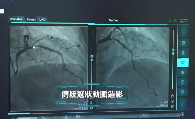 梁凱晴親眼見證了解「傳統冠狀動脈造影」與「caFFR（冠狀動脈造影-FFR）」嘅不同性。