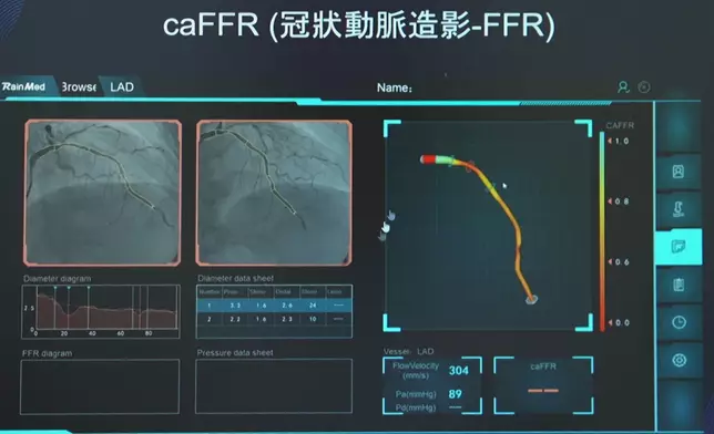 梁凱晴親眼見證了解「傳統冠狀動脈造影」與「caFFR（冠狀動脈造影-FFR）」嘅不同性。