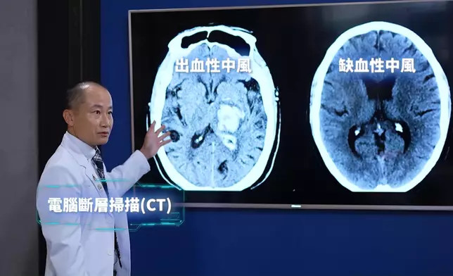 中風可分為「出血性中風」及「缺血性中風」兩大類。