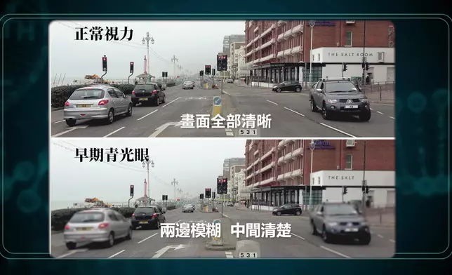 早期青光眼、晚期青光眼同正常視力嘅影像顯示。
