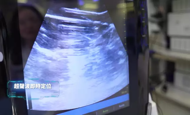「經皮下冷凍消融術」過程。