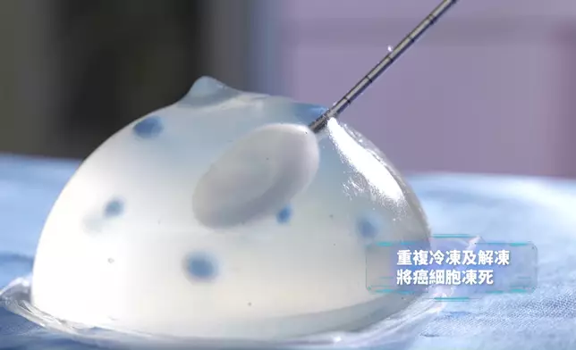 「經皮下冷凍消融術」過程。