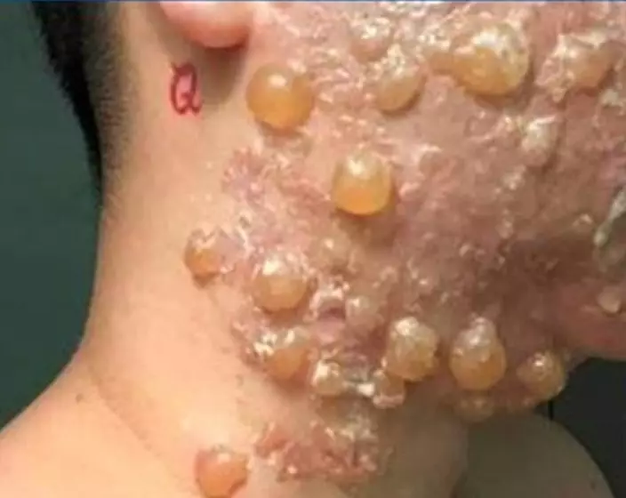 林女滿面水泡。網上圖片