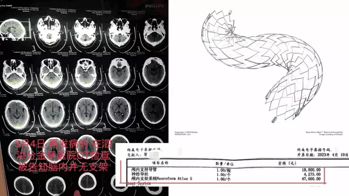 江蘇老翁腦梗病發，揭發醫院隱瞞腦血管支架安裝手術失敗。