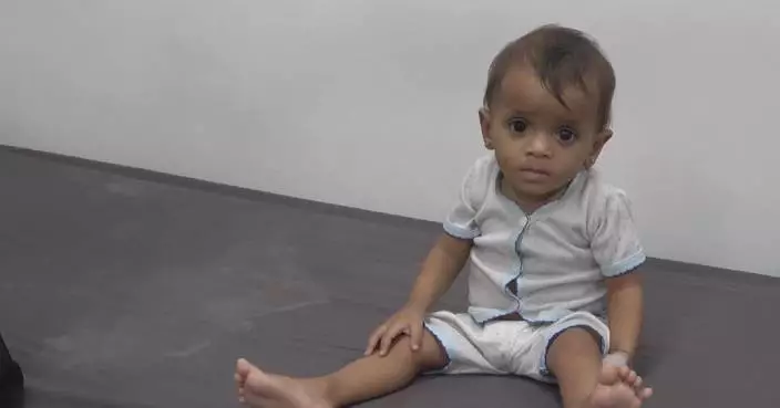 Children in war-torn Yemen suffer from malnutrition
