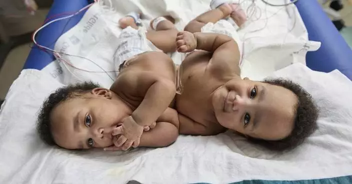 Twin boys born conjoined celebrate 1st birthday after separation surgery