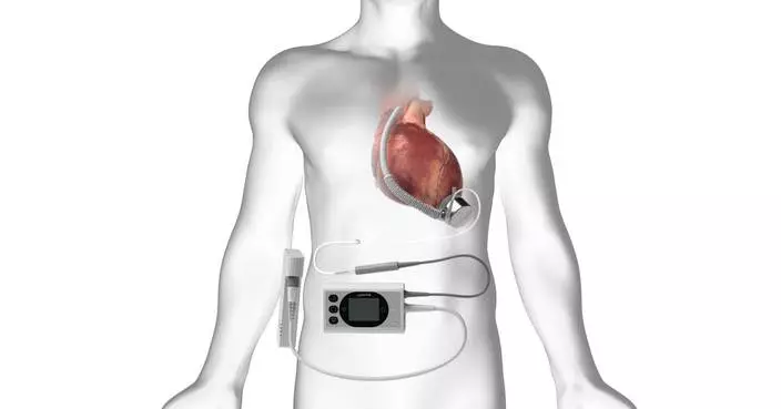 BrioHealth Solutions Begins Patient Enrollment in INNOVATE Trial of BrioVAD® System for Advanced Heart Failure