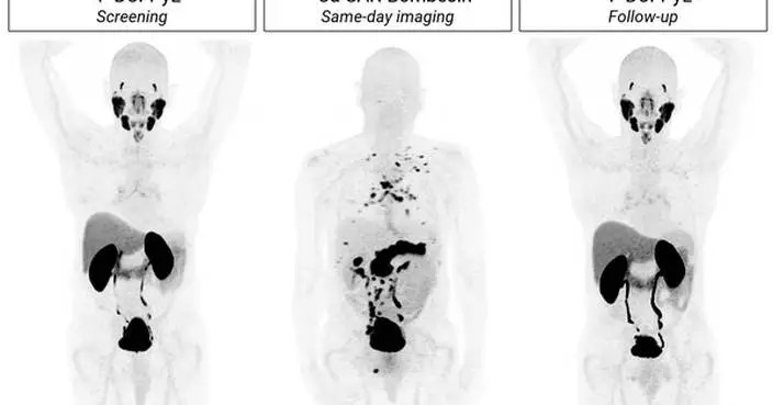 SABRE topline results: Cu-64 SAR-Bombesin is effective in detecting prostate cancer recurrence in patients with negative SOC imaging