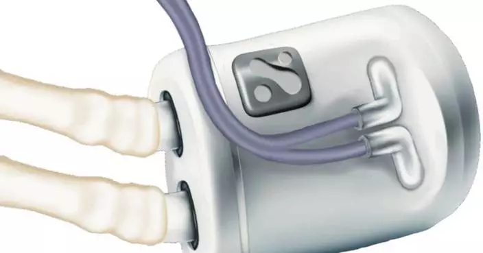 Nephrodite Earns FDA’s First Breakthrough Device Designation for an Implantable Kidney Replacement System