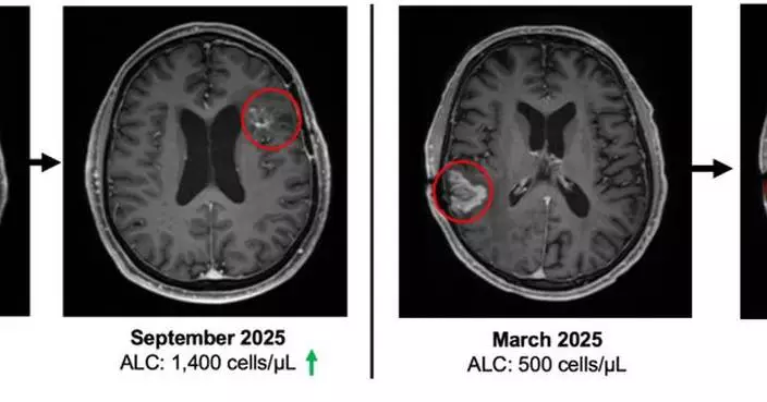 ImmunityBio Reports Median Overall Survival Not Yet Reached and Lymphopenia Reversed in Recurrent Glioblastoma Patients Receiving ANKTIVA® Plus CAR-NK, Chemo-Free Therapy