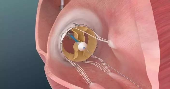 Trisol Medical Announces Positive Results from U.S. Early Feasibility Study of Its Transcatheter Tricuspid Valve Replacement System