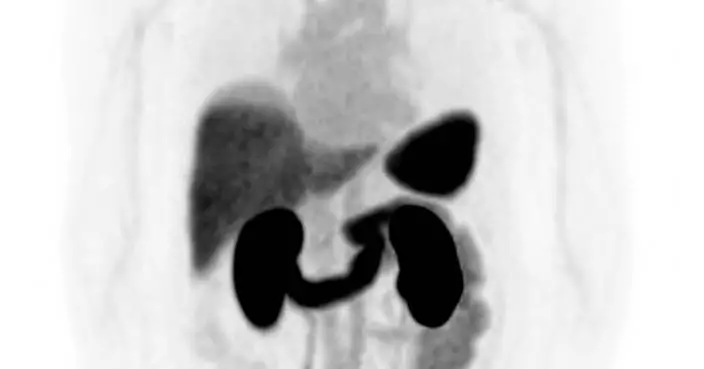 SECuRE trial to continue with no modifications to protocol following Safety Review Committee meeting
