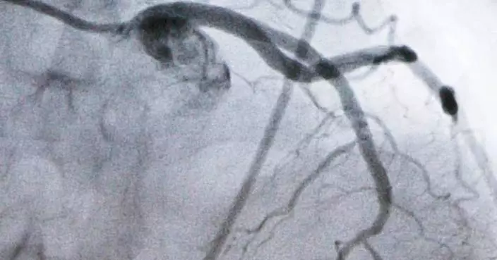 Experimental cholesterol-lowering pill may offer new option for millions