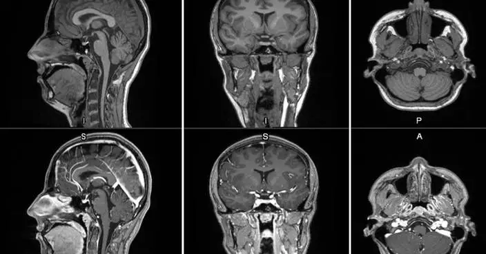GE HealthCare Announces First Patient Dosed in Phase 2/3 LUMINA Trial for Manganese-Based MRI Contrast Agent Under FDA Fast Track Designation, Further Advancing Its Innovation Pipeline of Novel Imaging Agents