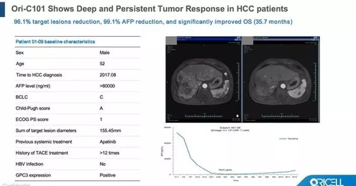 ASCO 2026 | Oricell’s GPC3 CAR-T Ori-C101 Hits 66.7% ORR in Late-Line HCC, Signaling Best-in-Class Potential