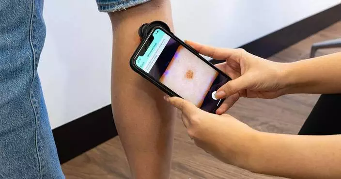 NHS England South East Rolls Out Skin Analytics' AI Skin Cancer Checks in the Largest Deployment of Autonomous Medical AI in NHS History