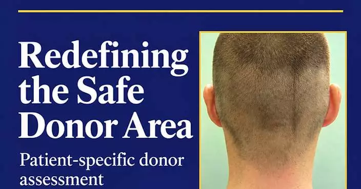 New hair transplant review challenges fixed donor limits