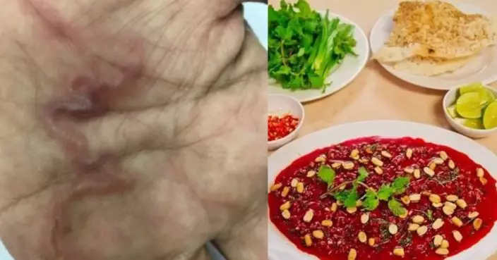 越南婦食地道小食「血凍」險死 寄生蟲大腦築巢掌心皮下清楚可見