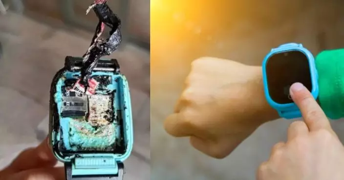 熱銷智能手錶疑電池出事爆炸 台灣小學生右手2度燒傷恐需植皮