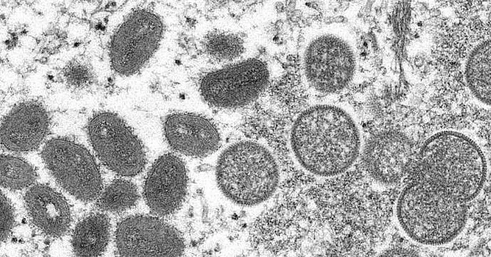 內地首次報告5宗女性猴痘確診 衛健委：未來或出現家庭傳播