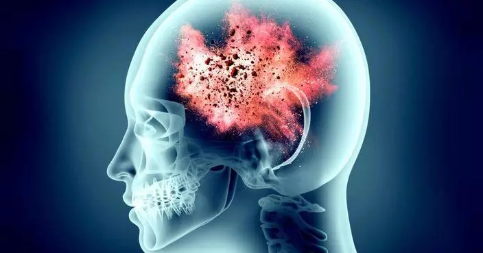 長新冠陷入「腦霧」狀態 牛津研究發現或是「血栓」惹禍
