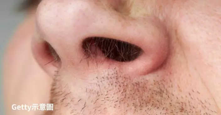 佛州男子臉部腫脹持續流鼻血就醫  竟「吸出150隻活蟲」震撼畫面曝光
