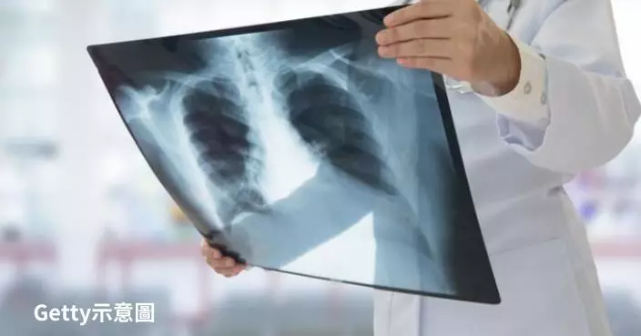 國外科學家研發「LungVax」肺癌疫苗 預防高達9成肺癌病例