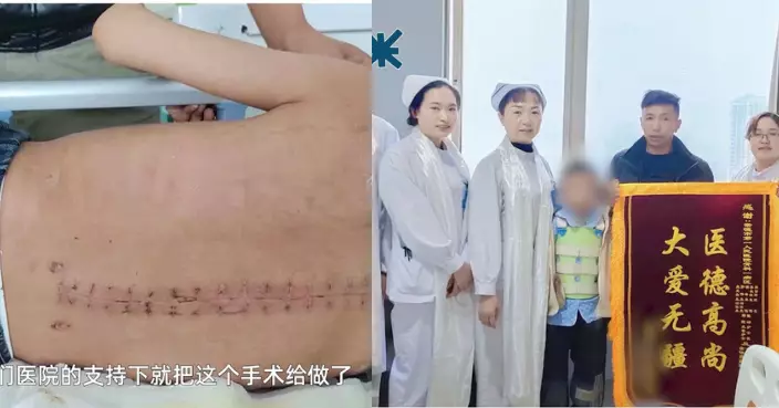 援藏醫生跨越3000公里接9歲男童手術 成功矯正脊柱身高增高3厘米