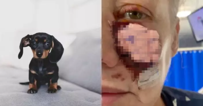 美婦遭友人臘腸犬突襲「臉上一塊肉」被咬兼吞下需縫40多針！