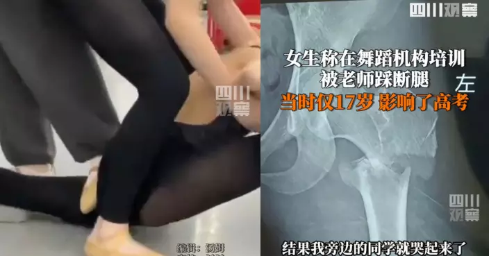 重慶17歲女學生學跳舞遭老師踩斷腿終身無法再跳 怒告涉事機構