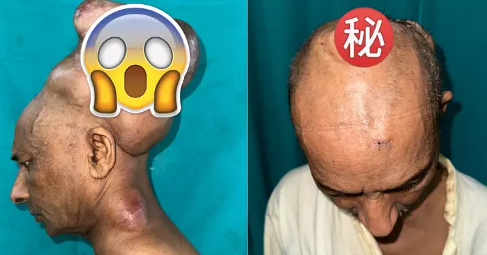頭頂「7公斤巨型肉瘤」30年！印度漢終於結束「硬頸」人生