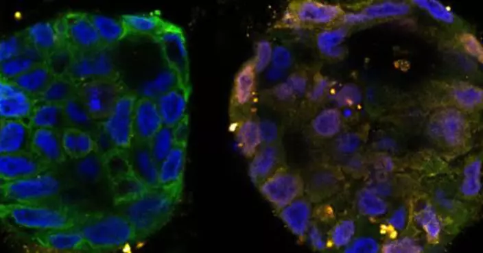 癌症治療新希望！研究：「殺手基因」SLFN11或將終結癌細胞