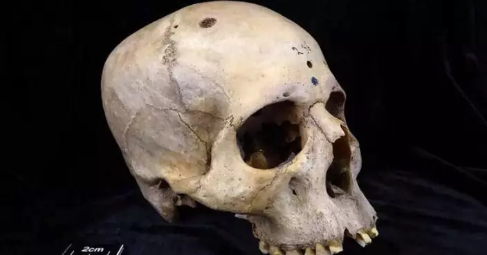 古埃及醫學如此先進！4600年前頭骨竟找到「治癌」痕跡