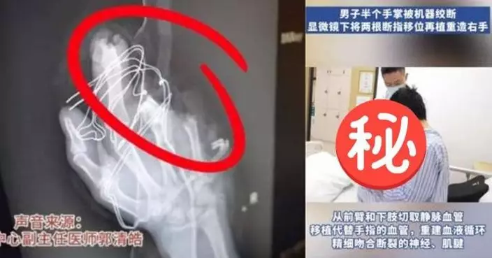 內地男手掌捲入機器絞斷剩兩指 醫生妙手「斷指移位」12小時重塑右手