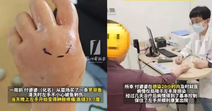 杭州婦劏羅非魚遭刺破手指感染創傷弧菌險截肢 醫生警告：死亡率極高