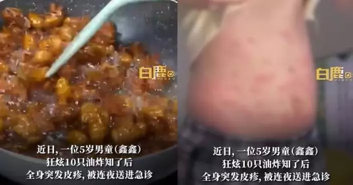 廣東5歲男童狂食10隻油炸金蟬後突發皮疹 醫生：呢類人群不宜進食