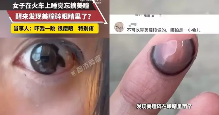 搭火車瞓覺突眼痛 內蒙女痛醒發現隱形眼鏡碎眼內驚恐萬分