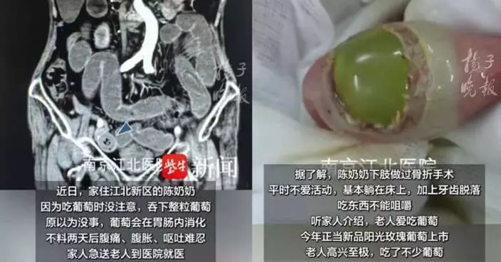 長者留意！吞整粒葡萄引發急性腸梗阻 南京8旬婦被急送醫做手術