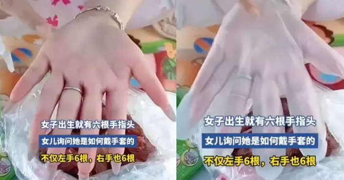左右手均有6隻手指 安徽女展示戴5指手套過程順暢引關注