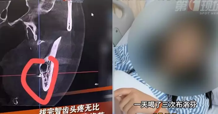 拔智慧齒後頭痛數日 深圳女回診驚揭手術針遺口腔內 歷逾4小時手術取出