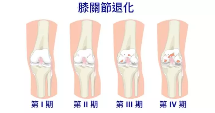 中西醫協作膝骨關節炎治療先導計劃 公院服務點增至5間