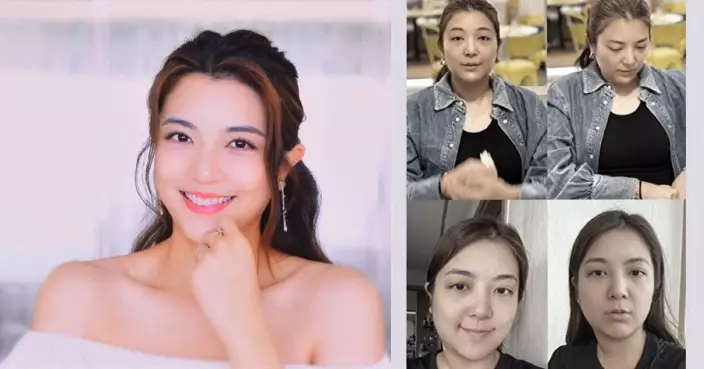 單文柔自揭眼睛發炎+臉頸腫脹逾月 好好休息調理身體終回復靚樣