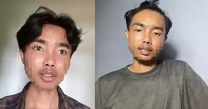 慎入!疑二手衣沒洗直接穿!TikTok網友染皮膚病曬「滿臉疣」影片