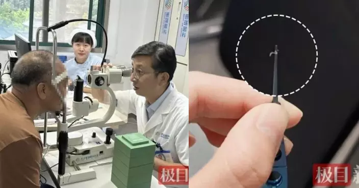 武漢男將飛蟲拍入眼痕癢10日 醫生從結膜囊夾出4活蟲