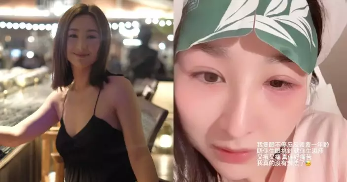 高海寧左眼受怪病纏繞 一年內反反覆覆生眼挑針生濕疹