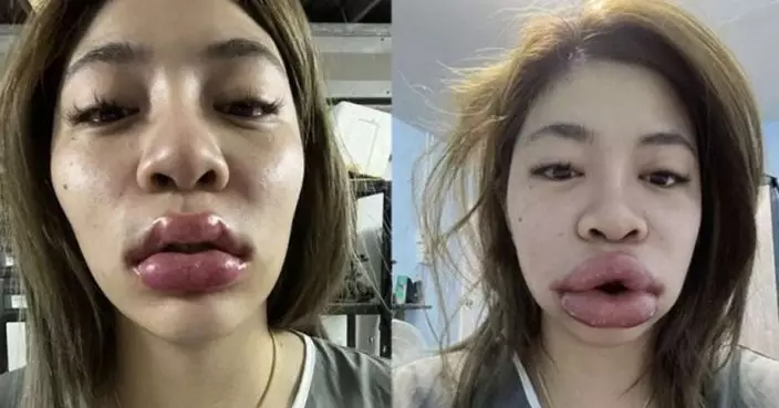 泰妙齡女打玻尿酸過敏變「孖腸嘴」發文警示 網民見原樣：好靚別再整