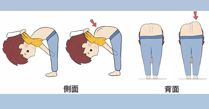 受訪一成半學童疑有脊柱側彎　專家籲及早治療避免惡化後做手術